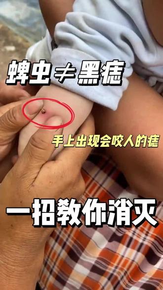 出现蜱虫一定要注意! #蜱虫 #蜱虫叮咬切勿生拉硬拽 #杀虫剂 #驱虫的妙招 #家用杀虫剂