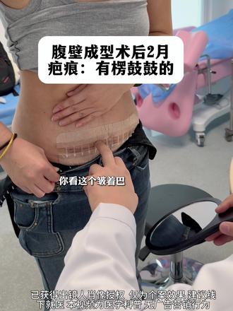 腹壁成型 疤痕,我这是做坏了吗?#八大处陈博 #腹壁成型 #腹直肌分离 #产后宝妈 #抖出健康新知识