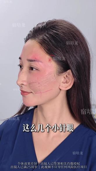 2026年即将流行的联合面部提升,不开刀,不留疤 #变美#面部提升#法令纹#宿培龙#筋膜提升