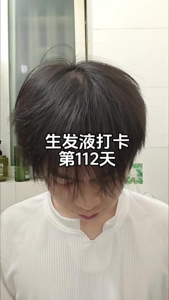 养发第112天,发际线有救了!#掉发 #增加头顶发量 #发际线 #养发护发