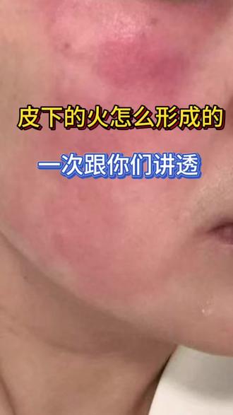 皮下的火到底怎么形成的,今天一次跟你们讲透#激素脸红肿热烫痒 #屏障受损#大红脸#激素脸