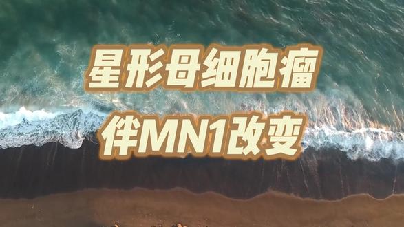 脑胶质瘤病理分类——星形母细胞瘤伴MN1改变 #梗阻性脑积水#抖出健康知识宝藏#women的健康我们帮#脑胶质瘤#星形母细胞瘤