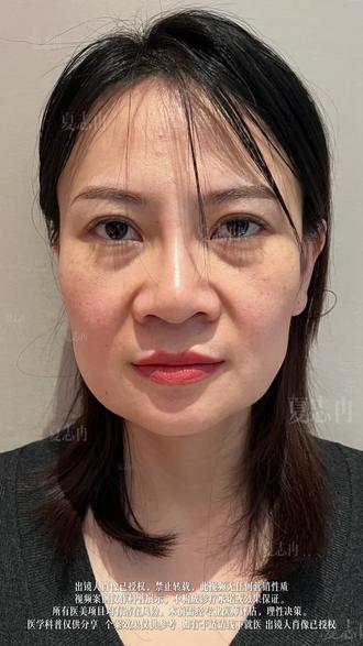 磨骨后垮脸提升,不想脸变宽,改善思路分享~ #面部提升#抖出健康知识宝藏#健康科普破圈计划#面部提升能维持多久