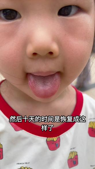 宝宝舌头受伤治疗恢复日记 #我的带娃闯关日记 #舌头 #受伤 #带娃的日子