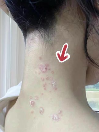 #皮肤 #牛皮癣 #皮肤健康