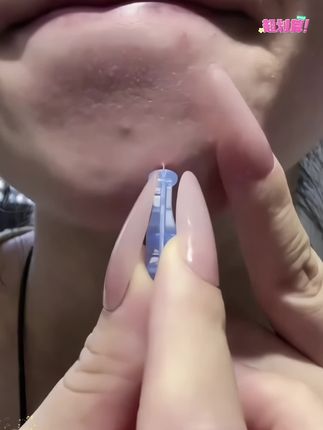 脸上爱长包包的姐妹!可千万别再用手挤了,这个一次性清洁工具真的巨好用!细得跟头发丝一样,不疼还不留印~#护肤#好物推荐🔥 #清洁神器#痘痘肌 #学生党好物推荐