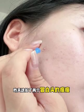 一次性无菌清痘粉刺闭口针超尖针美容院专用祛痘痘针去黑头细胞夹#种草好物 #学生党必备 #好物分享 #黑头