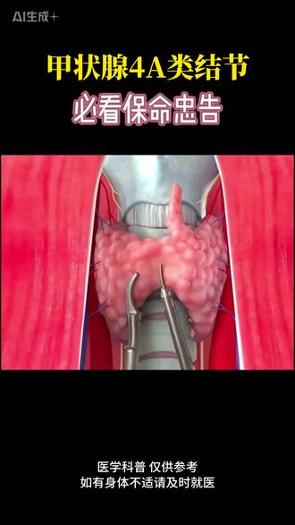 甲状腺4A结节别盲目开刀,医生给你支招 #甲状腺结节 #医学科普 #硬核知识局 #抖出健康知识宝藏 #医者仁心