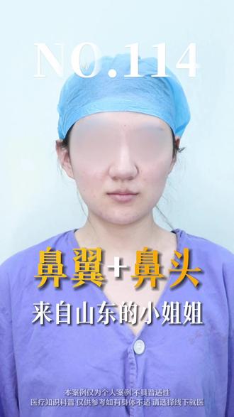百台鼻翼第二季NO.114,鼻头+鼻翼缩小 #鼻翼缩小 #鼻头缩小 #缩鼻翼