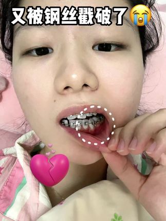 牙套女孩再也不用担心磨嘴了#皓齿舒 #正畸蜡 #钢牙磨嘴 #钢牙妹 #牙套