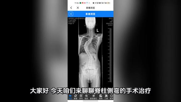 #脊柱侧弯@骨科宋相建医生