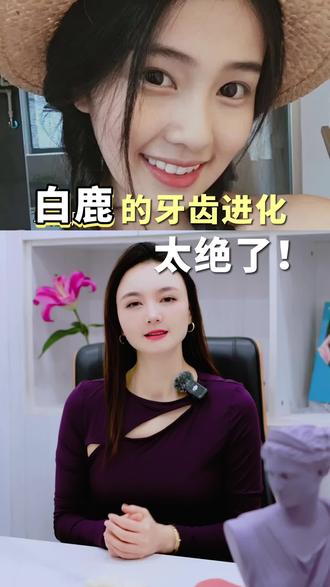 白鹿德牙齿进化,太绝了,美商思路决定结果。#美学设计 #美牙#微笑线#个性化设计 #全瓷贴面