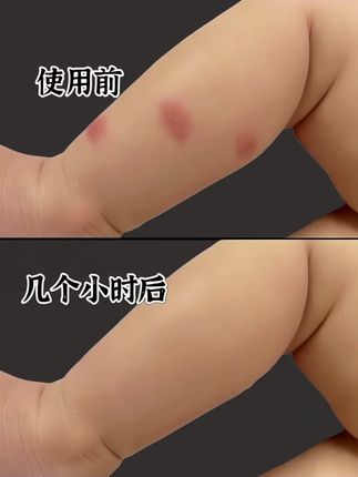 每年空管三支,霸榜不是没有理由的!家里有“招蚊宝宝”的一定要试试。它萃取天然金盏花精华,成分纯净温和,0激素添加,给宝宝用超安心。宝宝娇嫩肌肤被蚊虫叮咬都能放心涂,我家宝贝就是易招蚊体质,每次被咬后,一抹小绿管,不一会儿就又能快乐玩耍了。这个夏天,有它就再也不怕蚊子啦!赶紧给宝贝安排上~#防蚊必备 #儿童蚊虫叮咬止痒膏 #宝弘止痒膏