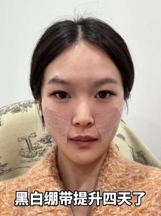 马上可以撕胶带了#原相机的自己 #面部提升 #日常记录 #法令纹