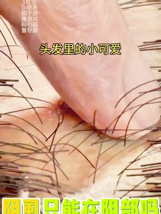 仁和药业百部酊喷雾剂男女阴用成人祛除虱子虱卵虱立净一扫光正品#长虱子怎么消除#消除虱子卵的小妙招#身上长虱子怎么消除#草本植物#百部酊喷剂