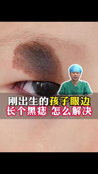刚出生的孩子眼边长个黑痣,怎么解决 #睑缘黑痣 #八大处陈文医生