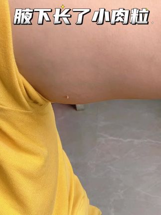 #腋下长小肉粒 #好东西一起分享 #好物测评