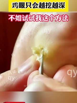 鸡眼只会越挖越深,不妨试试我这个方法#鸡眼#鸡眼跖疣 #鸡眼去除小妙招 #老茧 #鸡眼膏