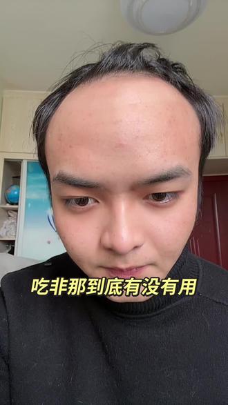 吃非那到底有没有#脱发#年纪轻轻秃头了怎么办