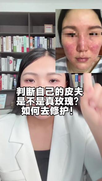 判断你的皮肤是不是玫瑰 如何去修护呢 #玫瑰脸修复 #大红脸敏感肌怎么修复 #玫瑰痤疮 #发红发烫起疹子