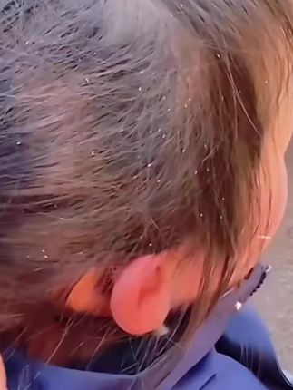 #虱子#虱子洗发水 #虱子卵 #虱子去除大法