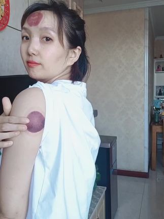 都说拔罐的时候疼,等你全身拔完,你就知道什么叫放松#拔罐