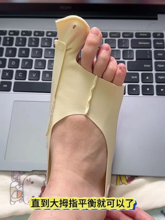 #大脚骨 #拇指外翻