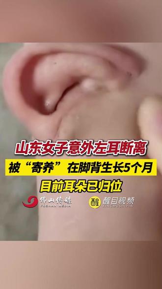 山东女子意外左耳断离,被“寄养 ”在脚背生长5个月,目前耳朵已归位!(出镜:刘畅;编辑:黄雅琳;责编:崔锦玥;素材来源:齐鲁晚报)#山东 #震惊 #耳朵 #社会新闻 #医疗 北京首例戒酒芯片手术实施