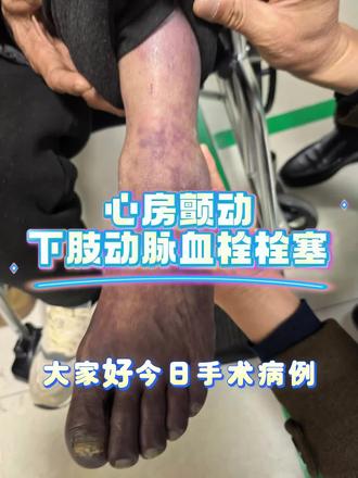 房颤心房内容易形成血栓,血栓脱落可能造成全身脏器的栓塞#房颤#下肢动脉血栓 #取栓 #徐州医科大学附属医院东院介入科 #医学科普仅供参考如有不适请线下就医