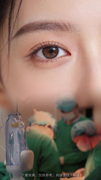 微创手术卧蚕,效果是永久的吗? #卧蚕修复 #微创手术卧蚕 #外眼角修复 #眼袋修复 #双眼皮修复