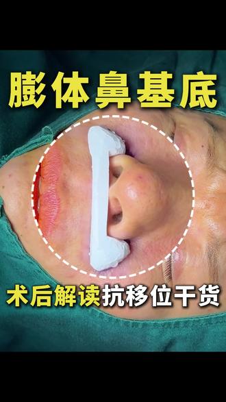 膨体鼻基底术后解读抗移位干货 #膨体鼻基底 #鼻基底凹陷 #鼻基底 #面中凹陷
