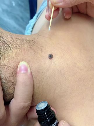 #经验分享 #精致女人必备 #脖子上的小肉粒