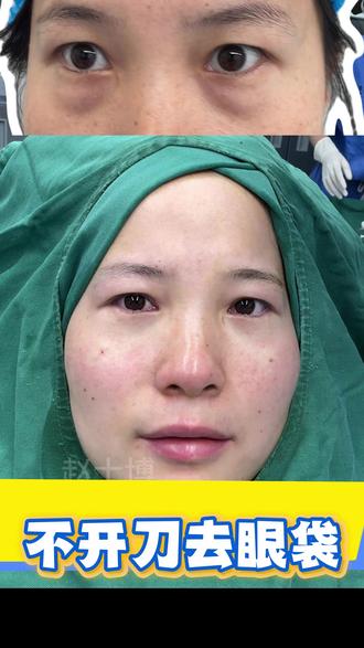 不开刀去眼袋 #去眼袋 #不开刀去眼袋