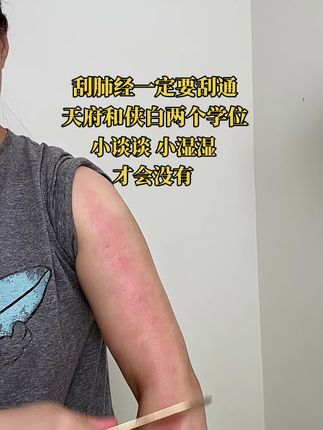 一定要把天府和侠白两个学位刮通,这样小谈谈小湿湿才会没有#刮痧的功效与作用 #刮痧