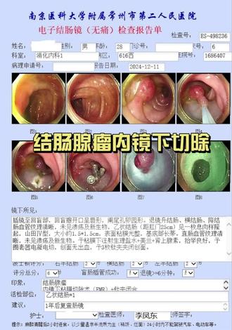 #结肠腺瘤 #结肠息肉 #息肉切除术 #结肠镜检查 #EMR 28岁男性,因排便次数增多,每天2-3次,就诊于消化内科,行无痛肠镜检查,提示乙状结肠息肉,活检病理提示管状腺瘤伴腺体低级别上皮内瘤变,收住入院,行肠镜下黏膜切除术(EMR),EMR术后病理示:管状腺瘤伴低级别上皮内瘤变,小灶高级别上皮内瘤变,切缘阴性。结肠息肉没有特异性症状,本次病例提醒我们要注重胃肠镜筛查,尤其年龄>45岁,有结肠腺瘤病史,或者直系亲属有结肠癌病史人群,早诊早治,早期消灭安全隐患。麻醉下无痛胃肠镜具有舒适化,快捷精准特点,不必因为对胃肠镜恐慌而放弃胃肠镜早期筛查。本次住院4天,花费6385.33元(医保报销前总费用)。