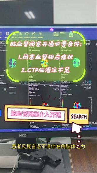脑血管闭塞介入开通:药物无效+症状+脑灌注减低是介入开通前提。#大脑中动脉闭塞 #科普健康知识 #介入开通 #脑血管病