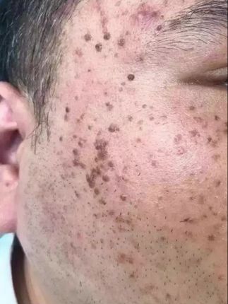 #皮肤问题#皮肤上的小肉粒 #变美就是这么简单