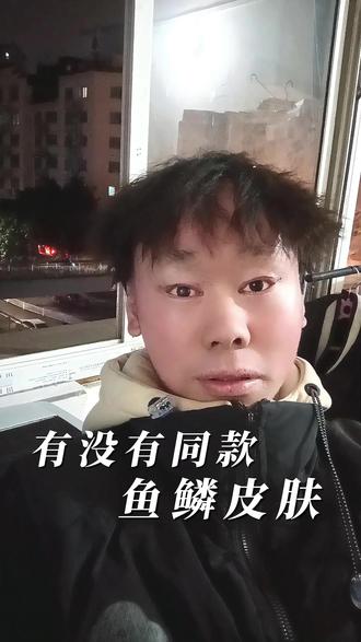 #鱼鳞皮 #鱼鳞皮肤 #鱼鳞皮肤怎么祛除 #鱼鳞病 #鱼鳞病康复