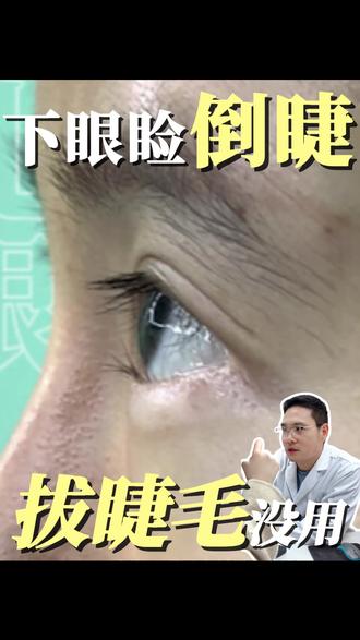 下眼睑倒睫 拔睫毛没用#上海九院顾钏#倒睫 #眼整形 #眼部 #倒睫毛 #倒睫手术