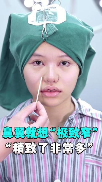 鼻翼想要“极致窄”,精致了好多噢~ #滑行皮瓣#减法鼻 #鼻翼缩小 #大鼻头缩小 #缩小鼻翼