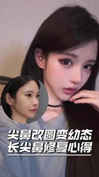 📝给姐妹们总结了以下几个超重要鼻修复显幼的细节!
1️⃣原本的鼻子显假显长显老,多半是因为山根或者山根起点过高,所以修复时适当降低山根与山根起点,在内眼角连线处,选择适合的高度才能缩短中庭,显幼态可爱!
2️⃣鼻额角要柔和流畅,不可以有断层或者过于平直!
3️⃣鼻背保留适当的微起伏,这也是原生骨骼感的体现,可以拉起面中,缩短中庭也提升了面部立体度!
4️⃣鼻尖上转折也是我要强调的部分,这处转折让整个鼻子更加灵动自然,精致度也大大增加!
5️⃣最重要的鼻尖是表现点,想从长尖鼻修复成显幼鼻,鼻尖表现点的位置一定要微微偏上,这样鼻子看着才会元气幼态,呈现直鼻微翘的外观,妈生感也拉满!
6️⃣小柱小叶部分要饱满圆润,不能内陷,这样鼻尖才会小巧灵动!
#变美逆袭 #鼻综合 #直鼻微翘 #鼻模板 #李荣喆