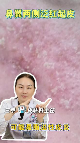 鼻翼两侧泛红起皮,可能是脂溢性皮炎 #医学知识 #健康科普 #科普一下 #脂溢性皮炎
