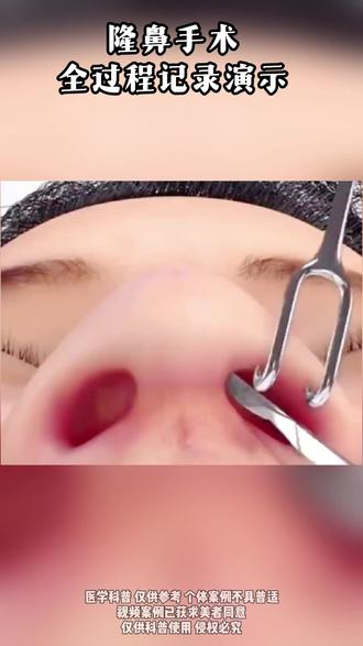 鼻整形必学~~~ #鼻整形 #隆鼻 #成都鼻整形 #邓东伟