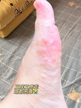 3. 谁懂啊!用对老品牌足部护理,小脚丫从“尴尬”变“清爽”,不痒不臭的感觉太爽了~#万万没想到 #可爱的小脚丫 #足部护理 #无处安放的小脚丫