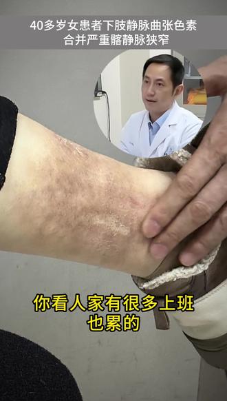 40多岁女患者:下肢静脉曲张色素合并严重髂静脉受压 做科普,惠民生❤ 上海九院血管外科主任医师|从手术台到科普,帮你守护血管健康// 分享下肢动脉硬化闭塞症,糖尿病足,静脉血栓/后遗症,主动脉瘤/夹层等血管外科疾病的医学科普知识// 感谢你的关注/点赞/评论/收藏/转发
#下肢静脉曲张 #血管外科殷敏毅 #上海九院殷敏毅 #中年人 #抖出健康知识宝藏