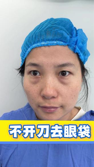 不开刀去眼袋 #去眼袋 #不开刀去眼袋