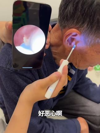 自从有了这个可视掏耳勺以后,抠耳朵再也不用盲掏了。看得清楚,掏的干净,家里有需要的可以安排的#可视扣耳勺 #亲测分享