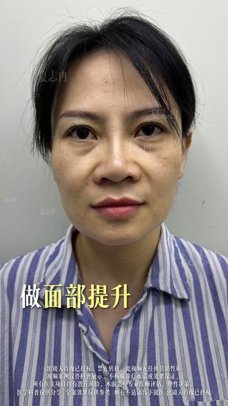 面部提升疼不疼?能维持多久? #苹果肌下垂怎么提升去#垮脸怎么办#面部提升做什么项目#口角囊袋怎么解决#面部提升夏志冉