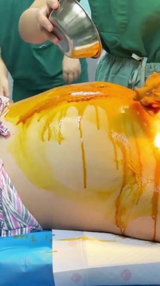 经历过的你还记得当时你是怎样的勇敢吗?#剖腹产 #生孩子 #宝妈