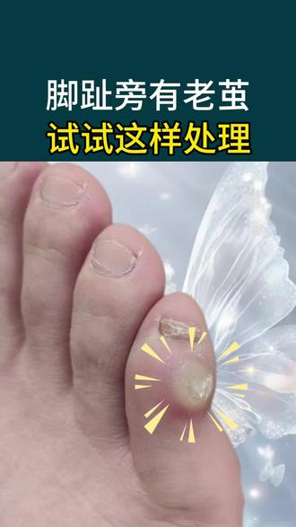 脚趾旁有硬茧,影响穿鞋走路怎么办?#脚底板的老茧怎么清除 #老茧 #老茧怎么去除 #老茧脚垫